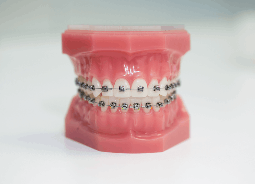 Brackets metalicos